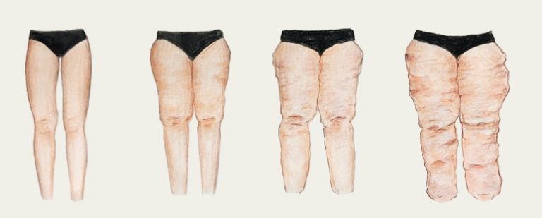 Lipoedoem udvikling i fire stadier, illustration