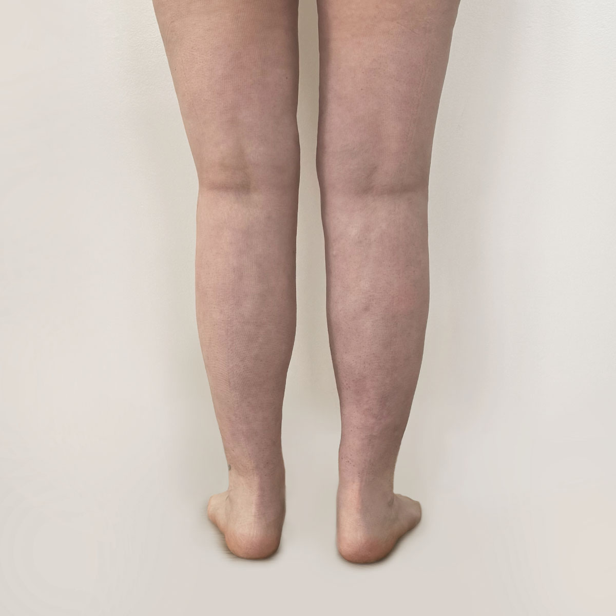 Efter lipoedem, på ben, set bagfra
